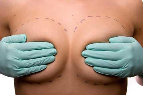 cirugia-de-implantes-mamarios