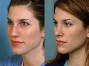 rinoplastias
