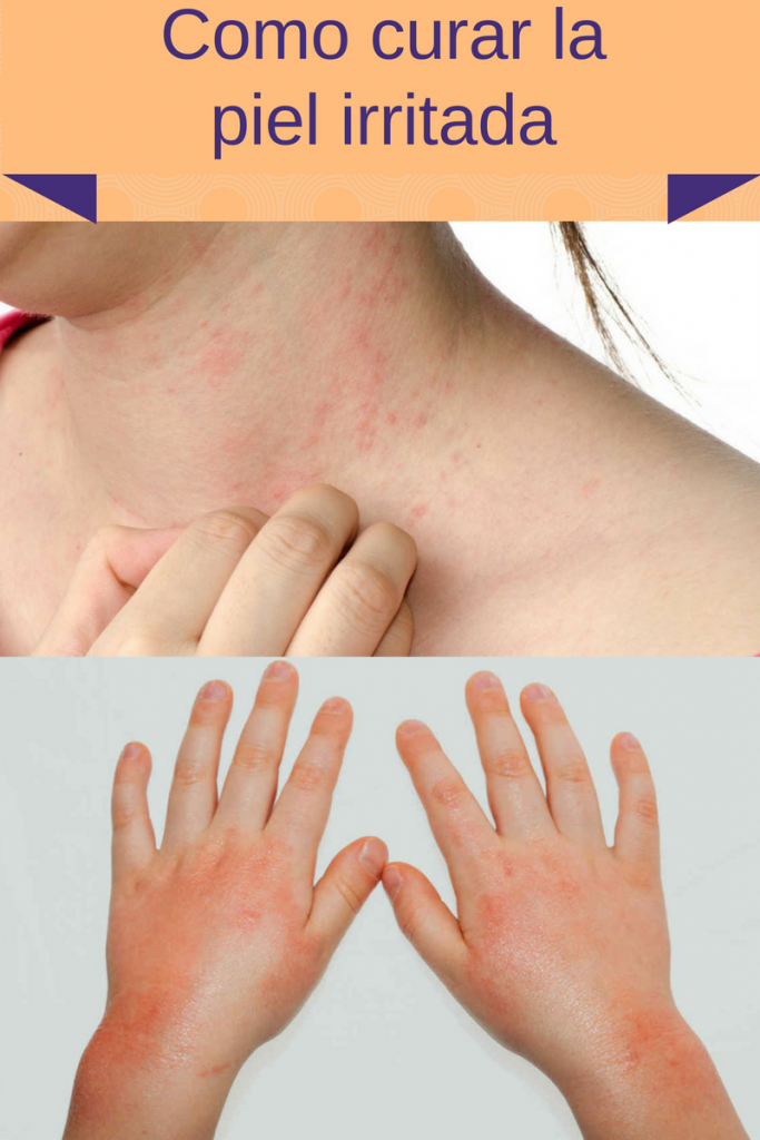 Remedios Naturales para calmar la piel irritada